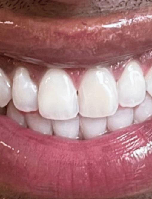 After NG Smiles