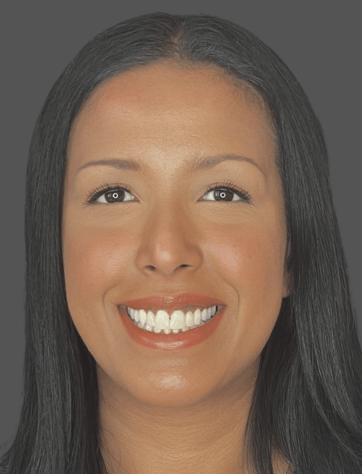 After Image  - NG Smiles