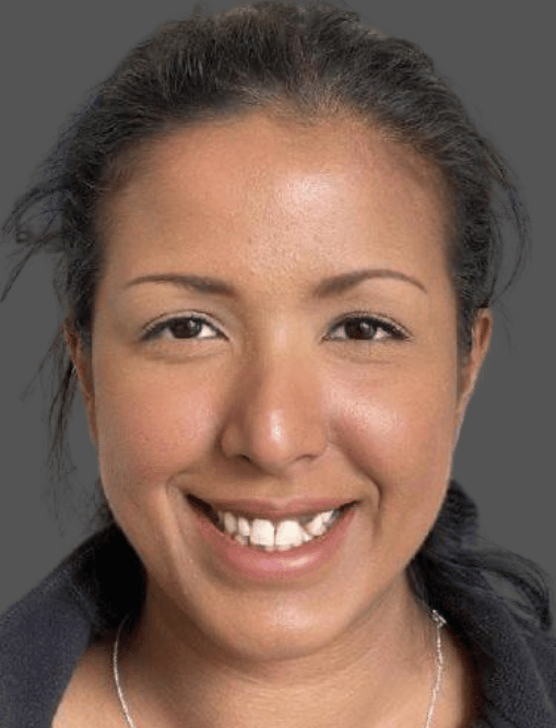 Before Image  - NG Smiles