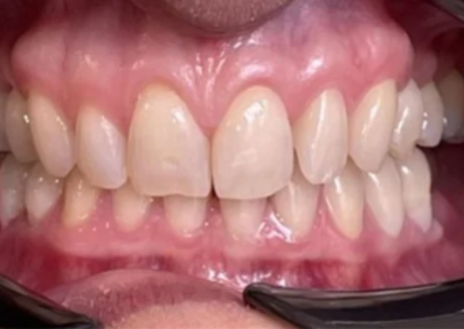 After - NG Smiles