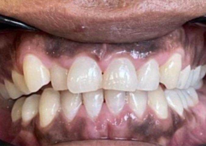After - NG Smiles