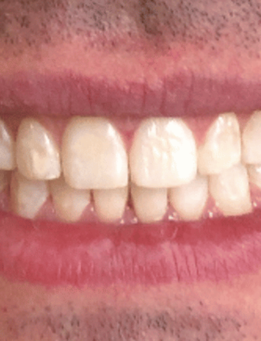 After NG Smiles