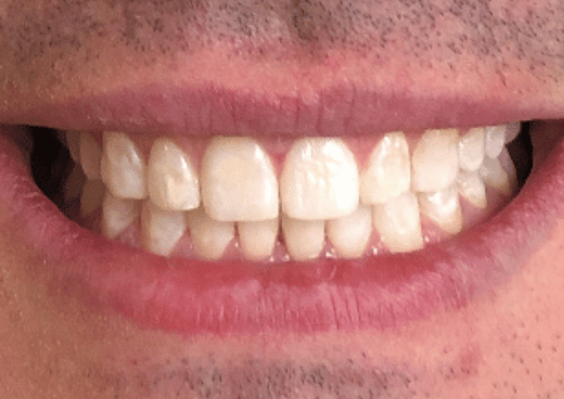 After NG Smiles