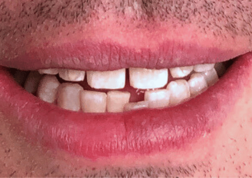 Before NG Smiles