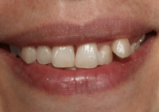 After - NG Smiles