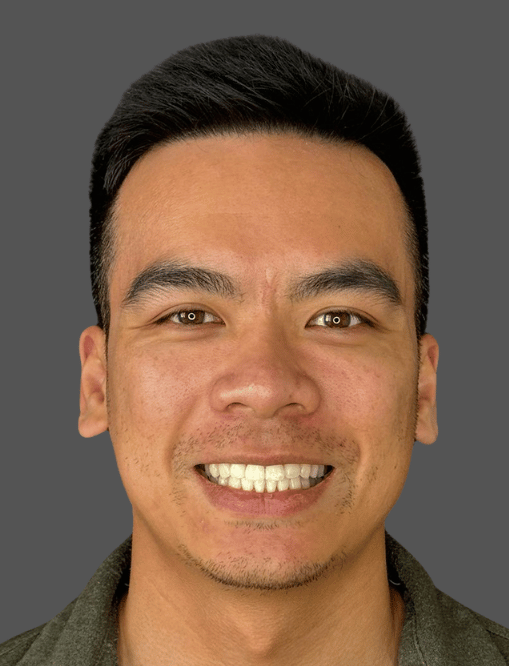 After NG Smiles