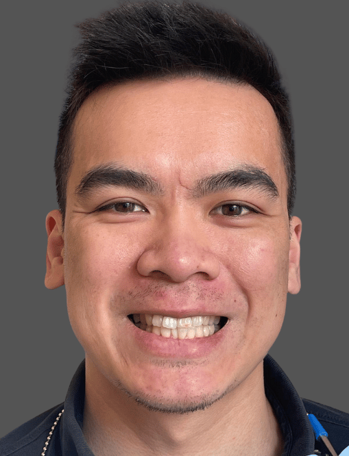 Before NG Smiles