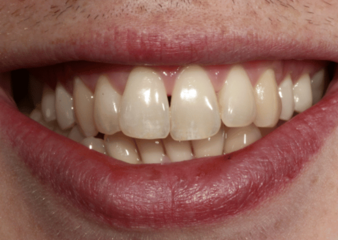 After - NG Smiles