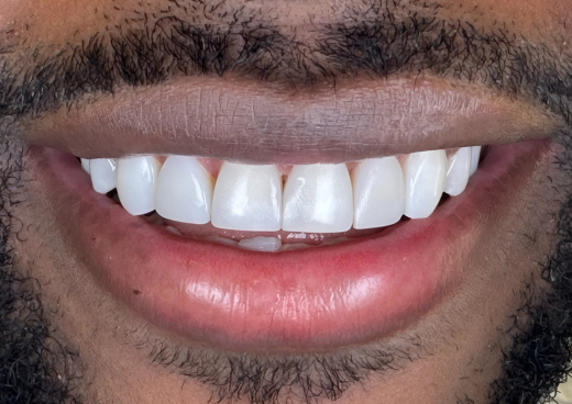 After NG Smiles