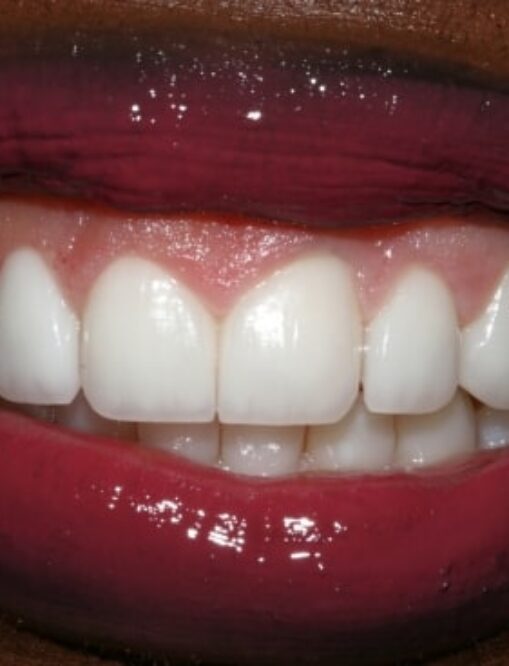 After NG Smiles