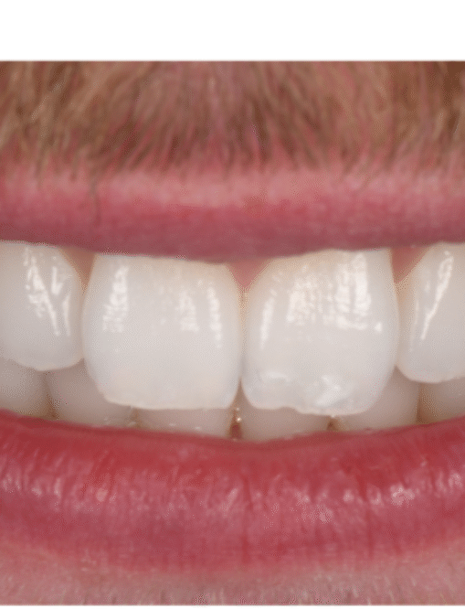 Before Image  - NG Smiles