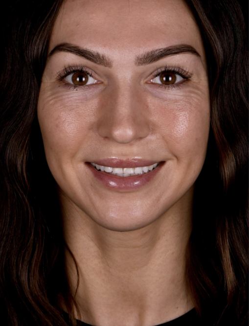 Before Image  - NG Smiles