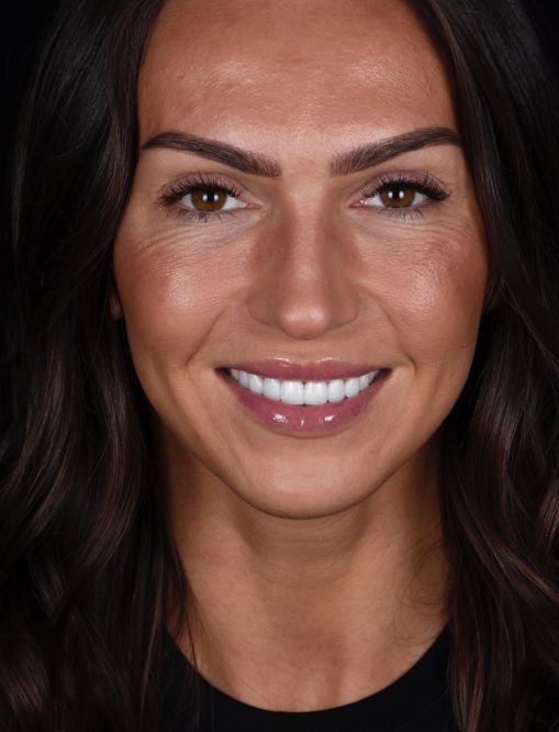 Before Image  - NG Smiles