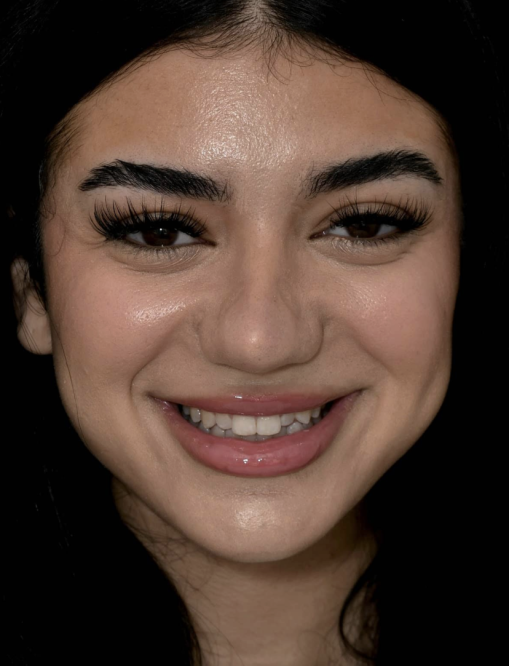 Before Image  - NG Smiles