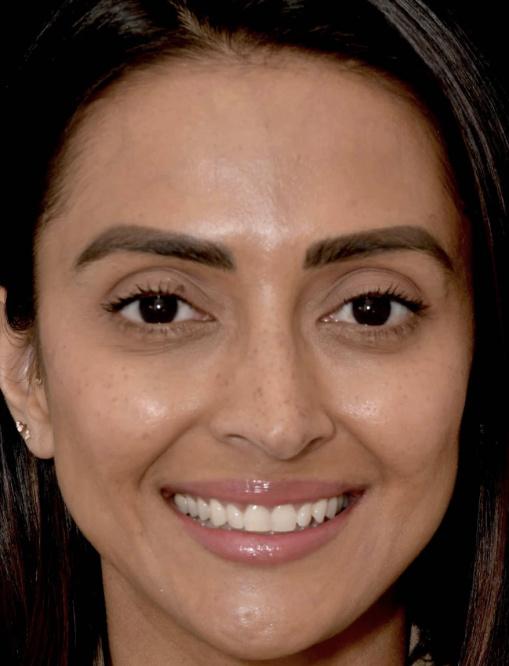 Before Image  - NG Smiles