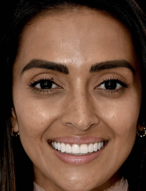 Before Image  - NG Smiles