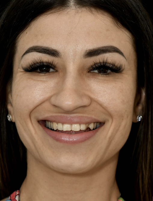 Before Image  - NG Smiles