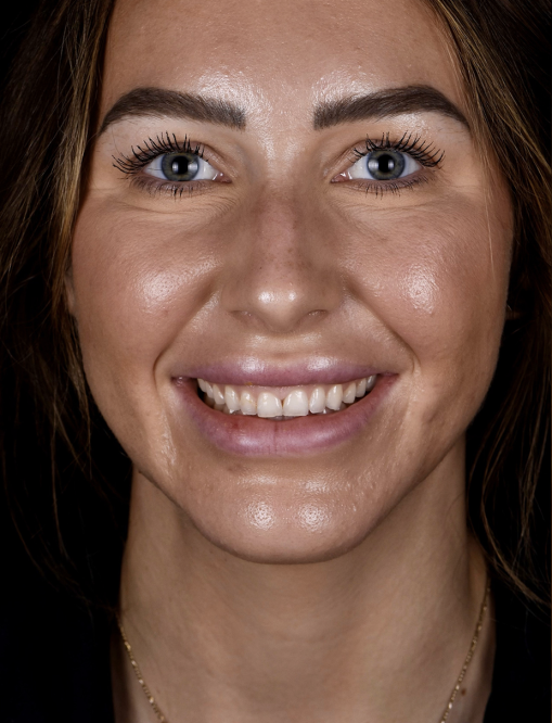 Before Image  - NG Smiles