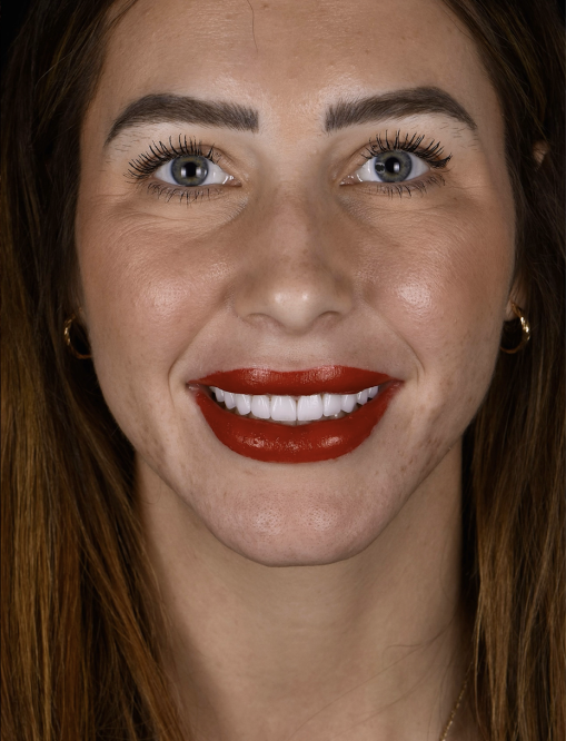 Before Image  - NG Smiles