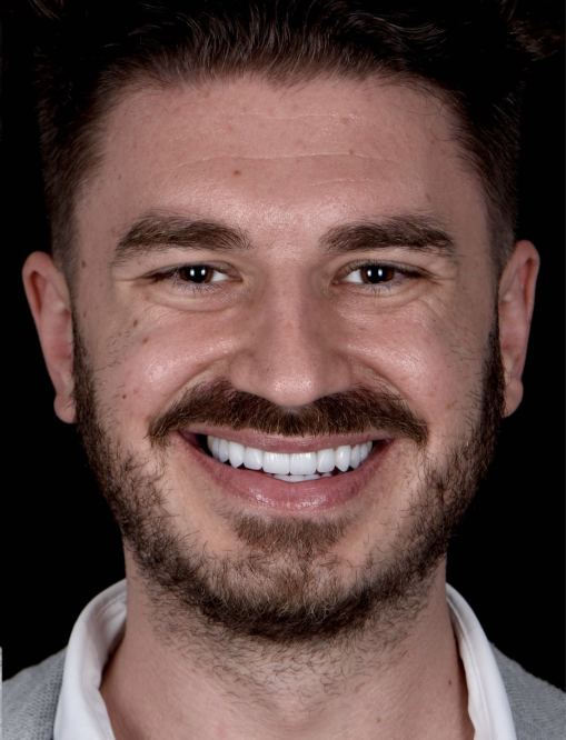 Before Image  - NG Smiles