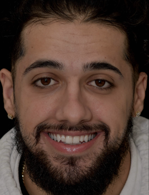 Before Image  - NG Smiles