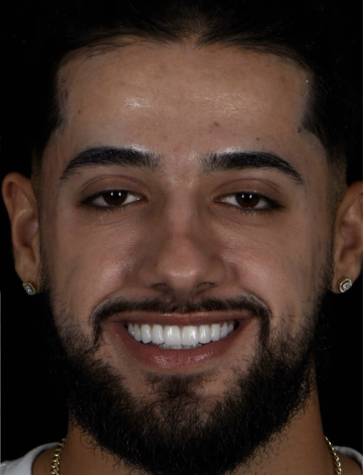 Before Image  - NG Smiles