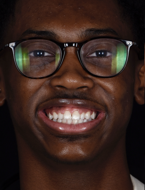 Before Image  - NG Smiles