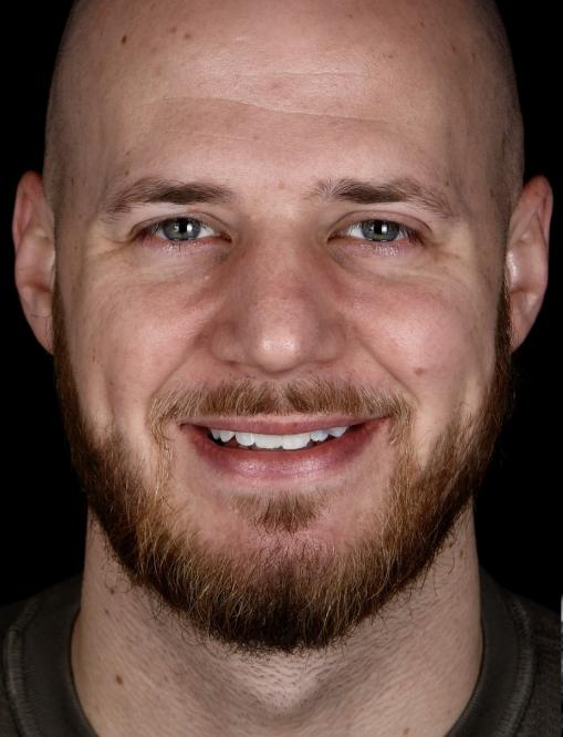 Before Image  - NG Smiles