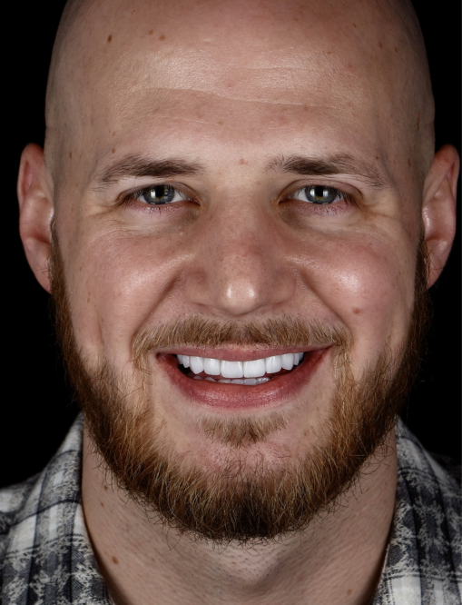 Before Image  - NG Smiles