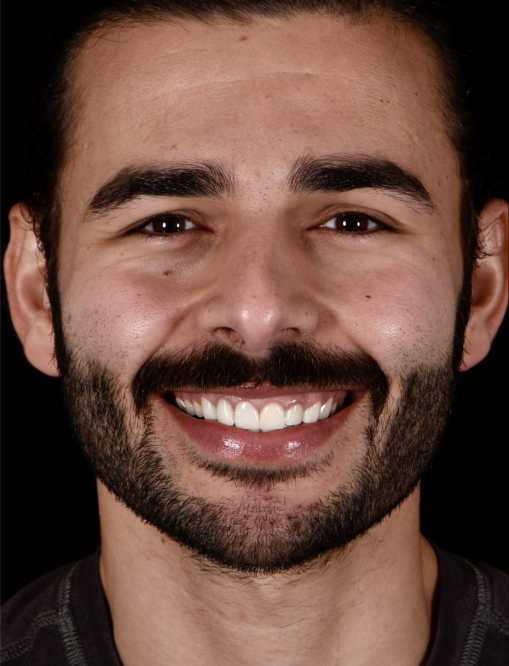 Before Image  - NG Smiles