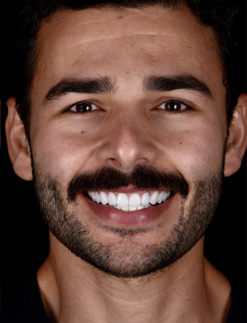 Before Image  - NG Smiles