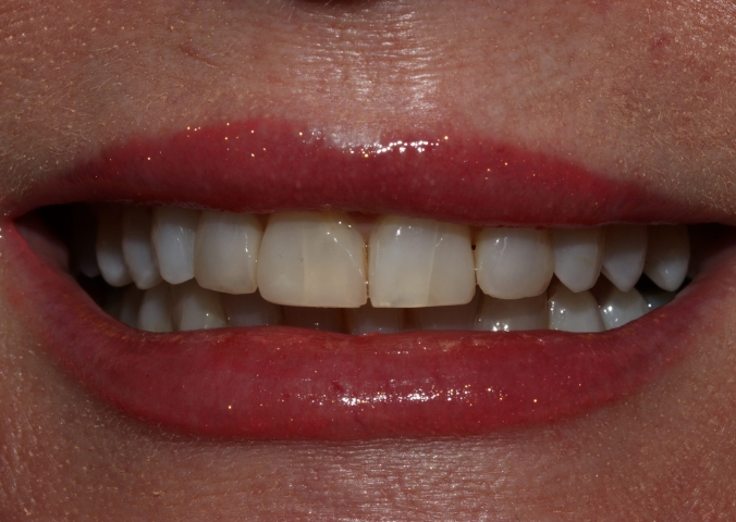 Case 2 before